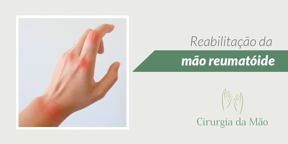 reabilitacao-mao-reumatoide