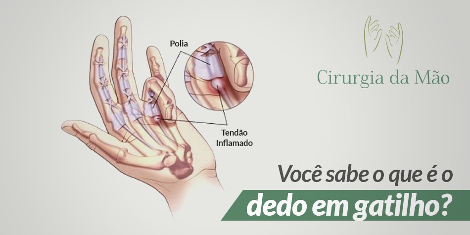 banner-dedo-em-gatilho-cirurgia-das-maos-v2